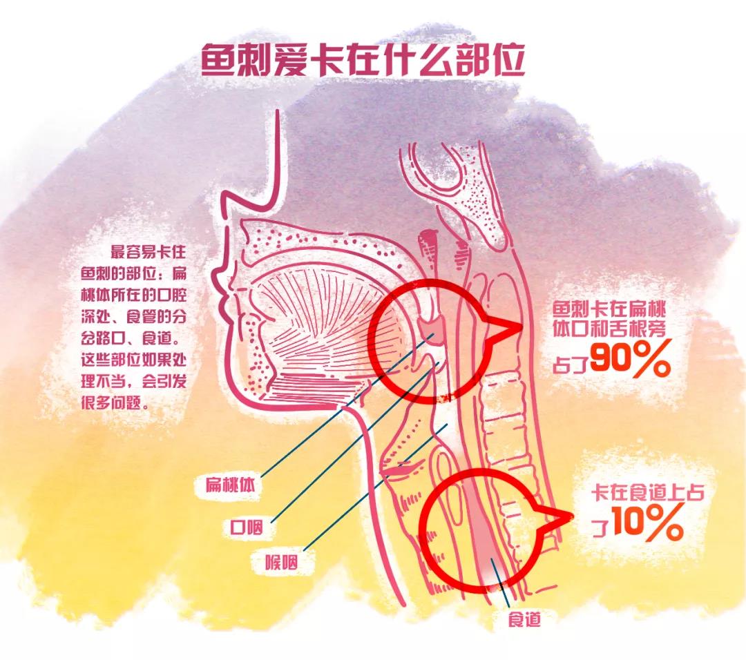 鱼刺卡喉的急救方法