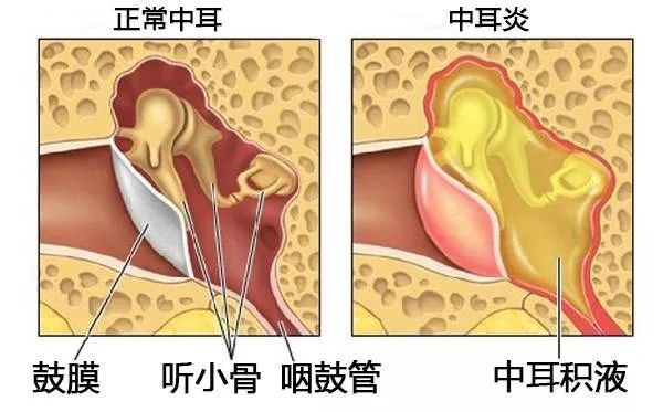 化脓性中耳炎