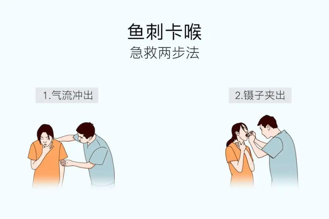 鱼刺卡喉的正确处理方法