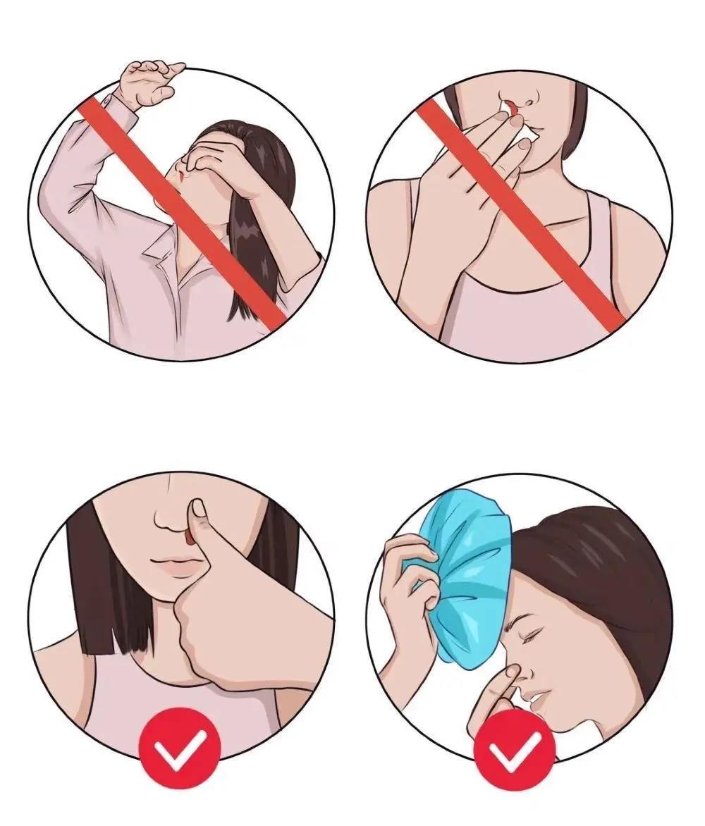 鼻出血的止血姿势