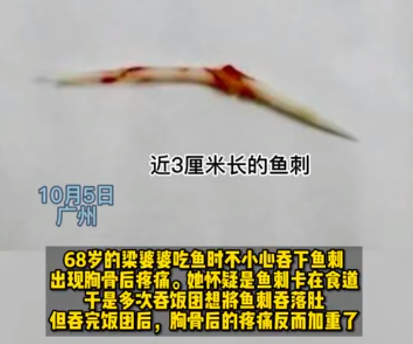 卡鱼刺