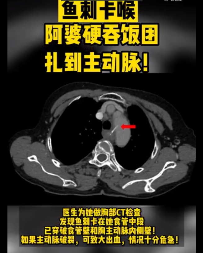 卡鱼刺