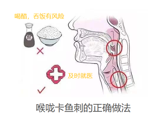 卡鱼刺的正确处理方法